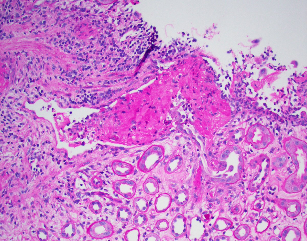 JZRenalPath's tweet photo. A not so uncommon finding (but not frequently discussed) in a kidney bx: tubulovenous fistula/herniation. Communication between a ruptured tubule &amp; vein with intravasuclar Tamm-Horsfall protein + thrombus. Can result in massive hematuria without a GN. #renalpath #PathTwitter https://t.co/oa9ky69Cw0