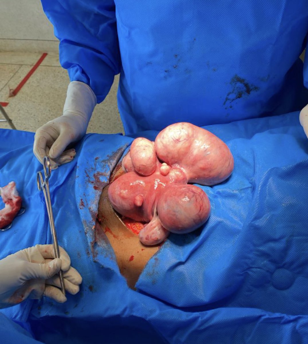 dr_katumwa's tweet image. 📌“An idle uterus is a Fibroids workshop”
Dear ladies, don’t take too long to get that first baby. Don’t make that uterus too idle for so long. Because it may cost you uterine fibroids.