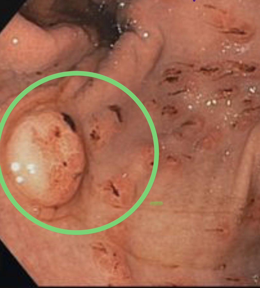 This patient had gastric erosions, duodenum ulcers (Forrest 2c) and a gastrin-secreting NET (circled), consistent with ZES.

Interestingly this case occurred outside the gastrinoma triangle - a reminder to be vigilant for NETs on endoscopy.

Case: cmaj.ca/content/191/49…