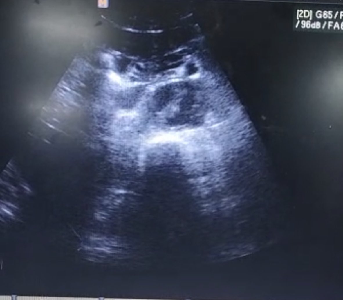 adomakoeugene_k's tweet image. Last 48 hours , 2 of these .50 y/o both came the CP.  One typical presentation the other not so typical. #POCUS  with ultrasound machine available as part of assessment and 👇🏾. Followed with a CTA which 👍🏾 an aortic dissection #pocusfirst #MedTwitter