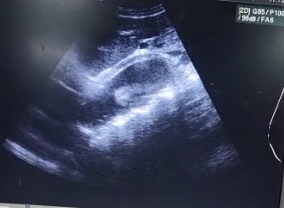 adomakoeugene_k's tweet image. Last 48 hours , 2 of these .50 y/o both came the CP.  One typical presentation the other not so typical. #POCUS  with ultrasound machine available as part of assessment and 👇🏾. Followed with a CTA which 👍🏾 an aortic dissection #pocusfirst #MedTwitter