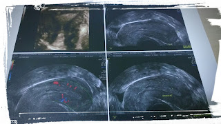 Eco 3d o Histeroscópia diagnóstica blgs.co/17Am5n