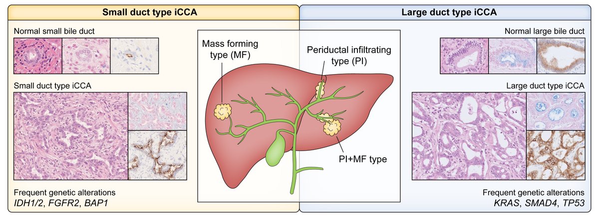 🆕#CPG in press❕

EASL-ILCA Clinical Practice Guidelines on the management of #IntrahepaticCholangiocarcinoma

🆓Find it here👉bit.ly/40p8suI

<a href="/EASLedu/">EASL Education</a>
<a href="/EASLnews/">EASLnews</a>
#iCCA
#LiverTwitter