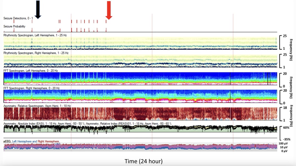 Neurocritical Care (@neurocritcarej) on Twitter photo Benedetti et al: Review of Noninvasive Neuromonitoring Modalities in Children II: EEG, qEEG
Link: ow.ly/GW4750NNNfe
<a href="/GiuliaBene16/">Giulia Benedetti</a> <a href="/neurocritical/">Neurocritical Care Society</a> #NeuroCritCare Benedetti et al: Review of Noninvasive Neuromonitoring Modalities in Children II: EEG, qEEG
Link: ow.ly/GW4750NNNfe
<a href="/GiuliaBene16/">Giulia Benedetti</a> <a href="/neurocritical/">Neurocritical Care Society</a> #NeuroCritCare