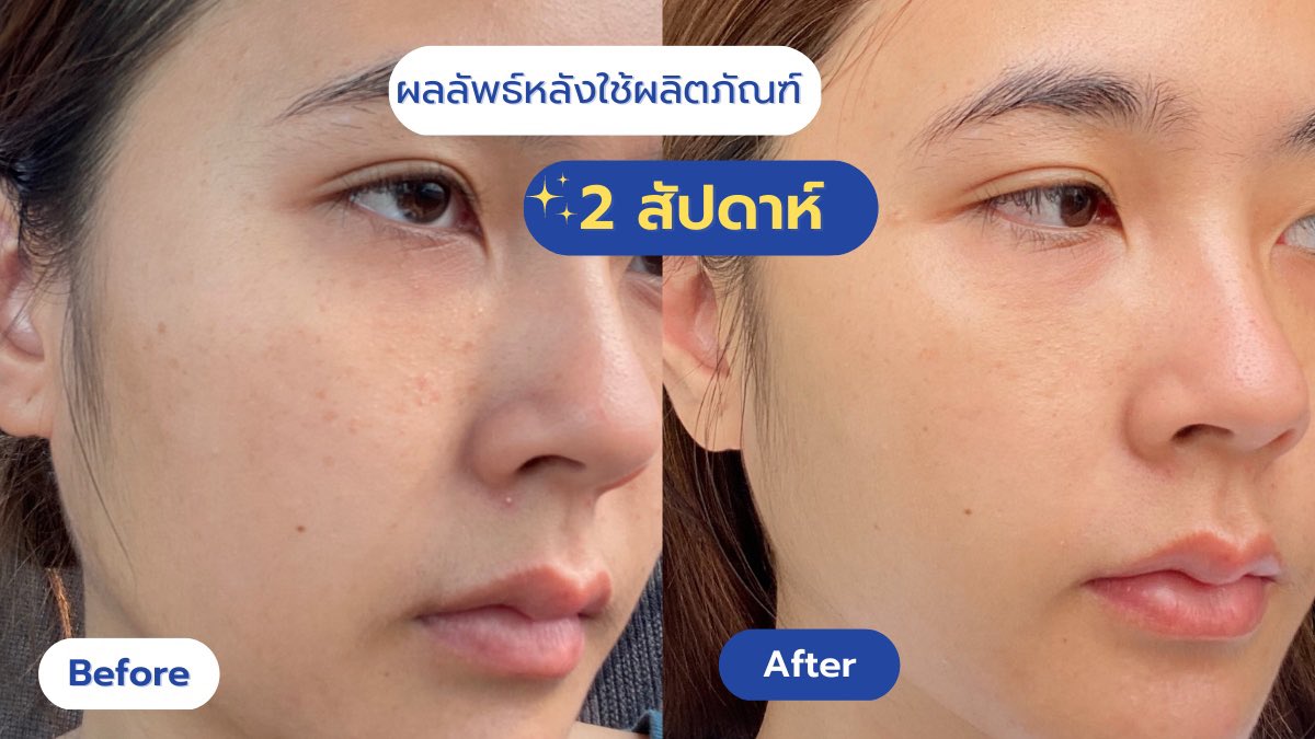 pureswann's tweet photo. อยากประกาศให้รู้ว่า จุดดำบนหน้าลดลงใน2สัปดาห์เพราะเซ็ตนี้เลย นีเวีย ลูมินัส630 จุดเด่นคือสารลูมินัส630 เป็นสารที่ยับยั้งการเกิดเม็ดสีที่ดีที่สุด! เมื่อเทียบกับสารไบร์ทเทนนิ่งอื่นๆ 
สมมงเซรั่มลดจุดดำอันดับ 1 ของโลก ทั้งรอยสิว รอยดำคือจางลงเร็วมาก เริ่ดมาก! https://t.co/0xiIYXNybY