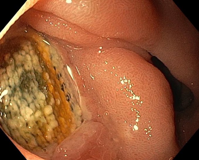 sepdigestiva's tweet photo. #QuizSEPD Inusual caso de úlcera duodena en paciente con demencia y hemorragia digestiva alta. ¿Cuál es el diagnóstico?🤔 https://t.co/AQndzidQfl