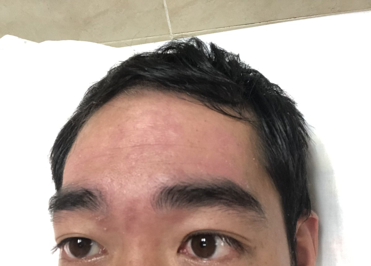 Noah_mex's tweet photo. 中南米で治安を気にする人、多いと思います。しかし、私たちの1番の敵は「蚊」です。僕はキューバでデング熱にかかり、気絶。救急車で運ばれてました。そのひと月前には、長期留学中だった中国人生徒が命を落としてます。ググると「高熱が出る」くらいしか書いてないですが、蚊除けは本気で徹底すべき https://t.co/9D7jaRZzhr