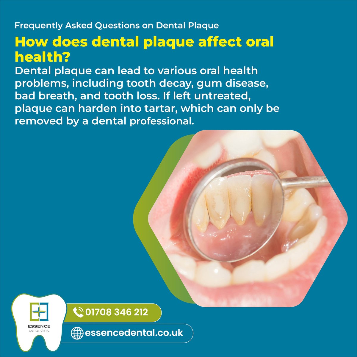 essencedental2's tweet image. Skipping proper dental hygiene routine can lead to dental plaque buildup. Make sure to brush twice a day, floss regularly, and visit us for regular cleaning to keep that plaque at bay!

#DentalHygiene #OralHealth #BrushingTips #PlaquePrevention