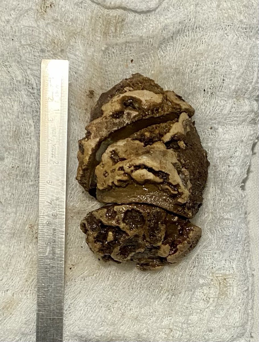 SudheerDevana's tweet photo. Congenital abnormal kidneys have tendency for formation of renal stones of unusually large size. This is one such example where we performed #robot assisted #pyelolithotomy. #urolithiasis #kidneystone #endourology #roboticsurgery https://t.co/b7zYAyGdVQ