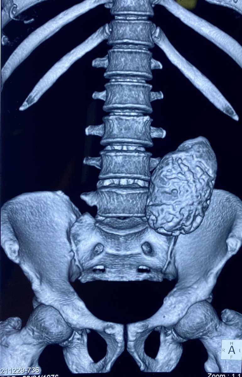 SudheerDevana's tweet photo. Congenital abnormal kidneys have tendency for formation of renal stones of unusually large size. This is one such example where we performed #robot assisted #pyelolithotomy. #urolithiasis #kidneystone #endourology #roboticsurgery https://t.co/b7zYAyGdVQ