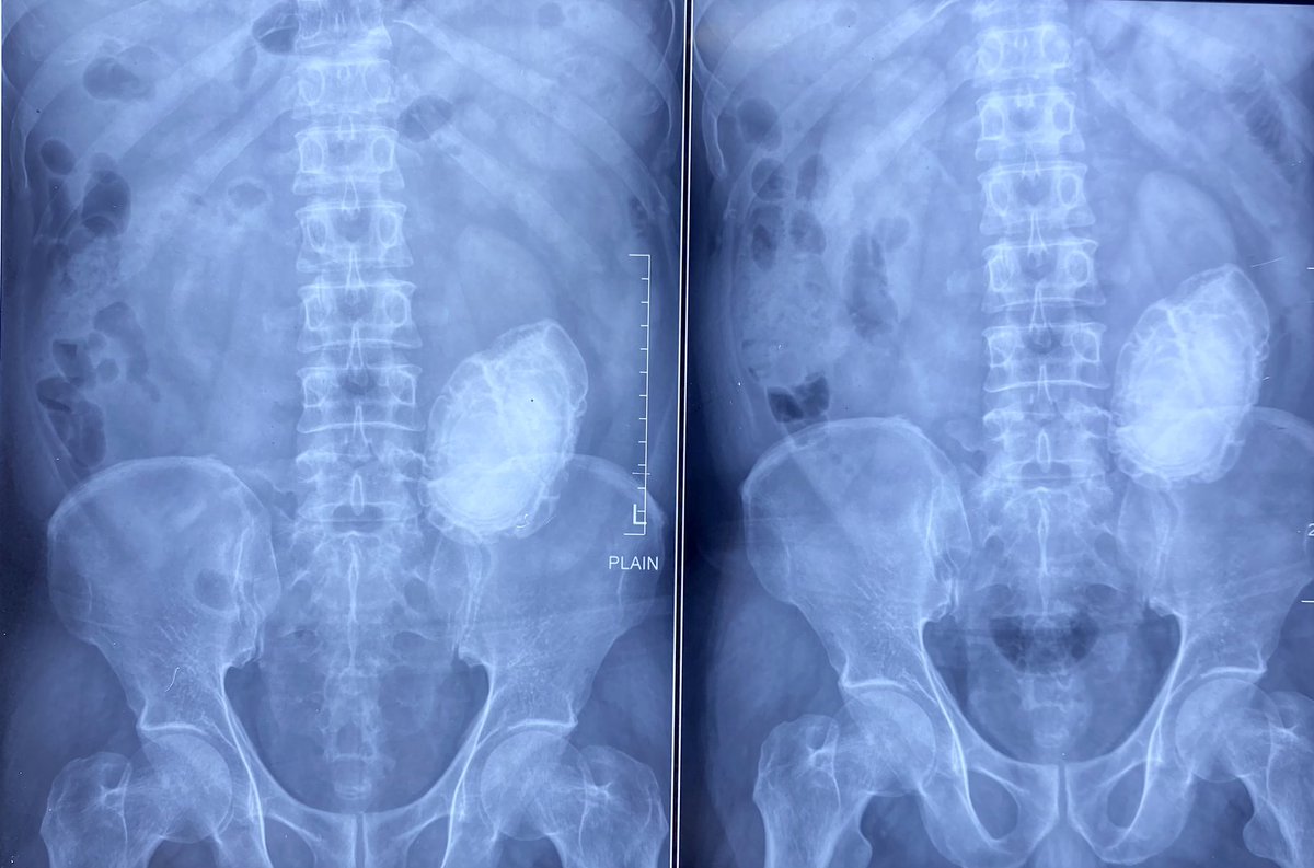 SudheerDevana's tweet photo. Congenital abnormal kidneys have tendency for formation of renal stones of unusually large size. This is one such example where we performed #robot assisted #pyelolithotomy. #urolithiasis #kidneystone #endourology #roboticsurgery https://t.co/b7zYAyGdVQ