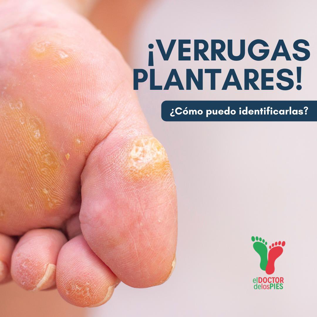 Podiatrasilva's tweet photo. ¡Verrugas plantares!

¿Qué son? 👉 Las verrugas plantares son tumores pequeños y ásperos en los pies🦶 . Suelen aparecer en la región metatarsofalángica y los talones de los pies, las zonas que soportan mayor presión. Esta presión también puede hacer que la verruga crezca https://t.co/x5lPIXwGVH