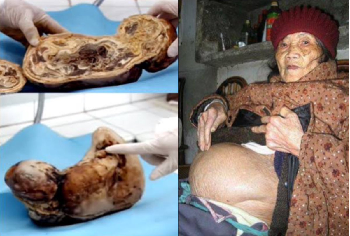 คุณยาย Huang Yijun วัย 92 ปี ชาวจีนมีทารกหินอยู่ในครรภ์นานกว่า 60 ปี เนื่องจากทารกเสียชีวิตในครรภ์มีหินปูนเกาะจนกลายเป็นหิน ความยากจนทำให้ไม่ได้ไปผ่าออกปล่อยไว้จนเวลาล่วงเลย แต่ในระยะหลังทนปวดท้องไม่ไหวต้องให้แพทย์ช่วยผ่านำซากทารกออกมา