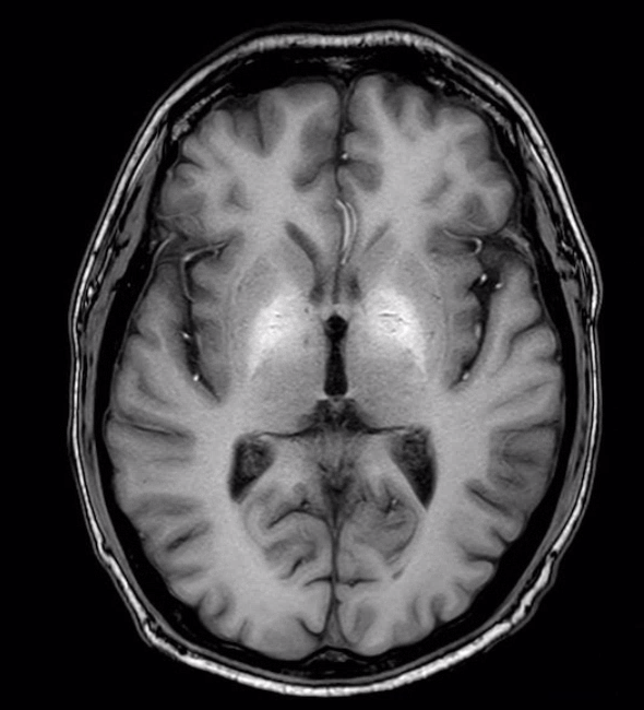 Weil wir gerade dabei sind. Neuroradiologie-Bilderrätsel:

Wer kennt die Diagnose, welche ein Klassiker der Inneren Medizin ist?

Als Hilfestellung: Das ist eine MRT T1-Sequenz ohne Kontrastmittel.