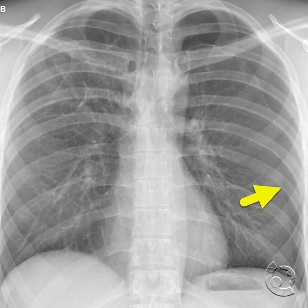 CincyKidsRad's tweet photo. Frontal radiograph (image 1) of the chest shows a large left pneumothorax (arrow). Focused radiograph at the left lung apex (image 2) shows the pneumothorax, as well as a large pulmonary bleb (arrowhead). Coronal CT images (images 3 and 4) and 3-D reform… https://t.co/EOKQNbIRFo https://t.co/taSytEHCPM