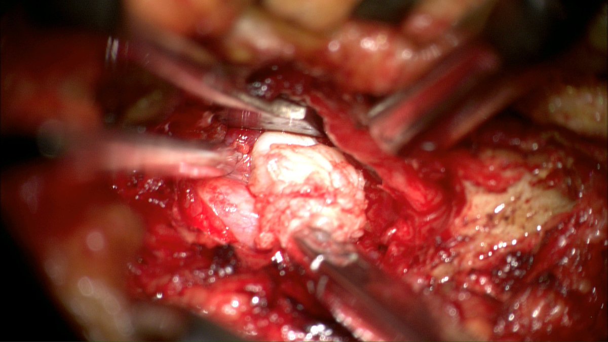 patrigtarno's tweet photo. Love when the hernia pops out 💥 @BlascoGA https://t.co/Vu7K1IZNX9