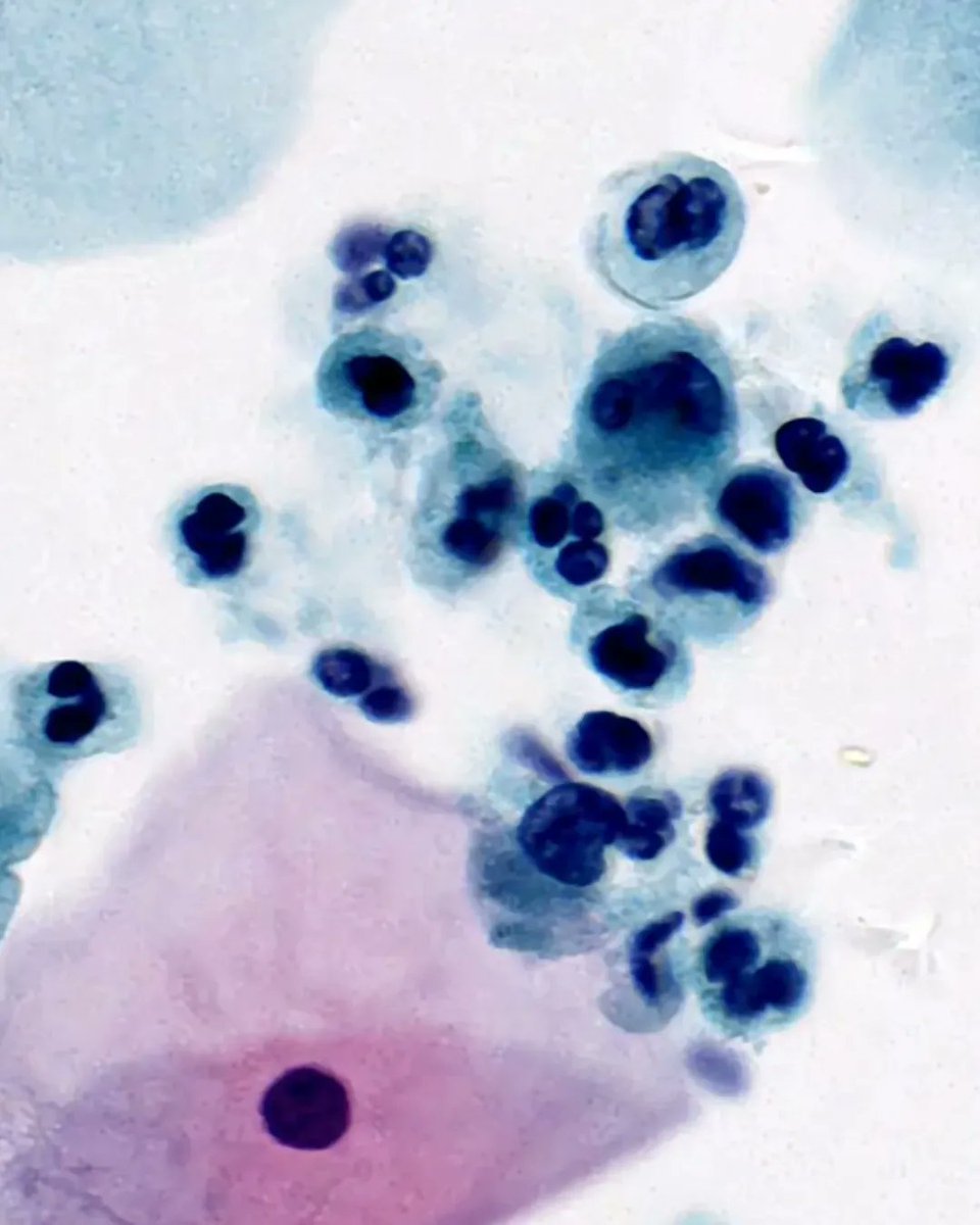 olkazuraw's tweet photo. Admiring the epithelial cell
and neutrophil morphology @100x!
This is art
Image source: Bionovation slide gallery
Stain: Papanicolaou
Sample: Cervical cast-off Cells
@clinpathkate, what do you think about the quality?
#papanicolaou
#epithelialcell
#pathart https://t.co/eZAr7vDXY9