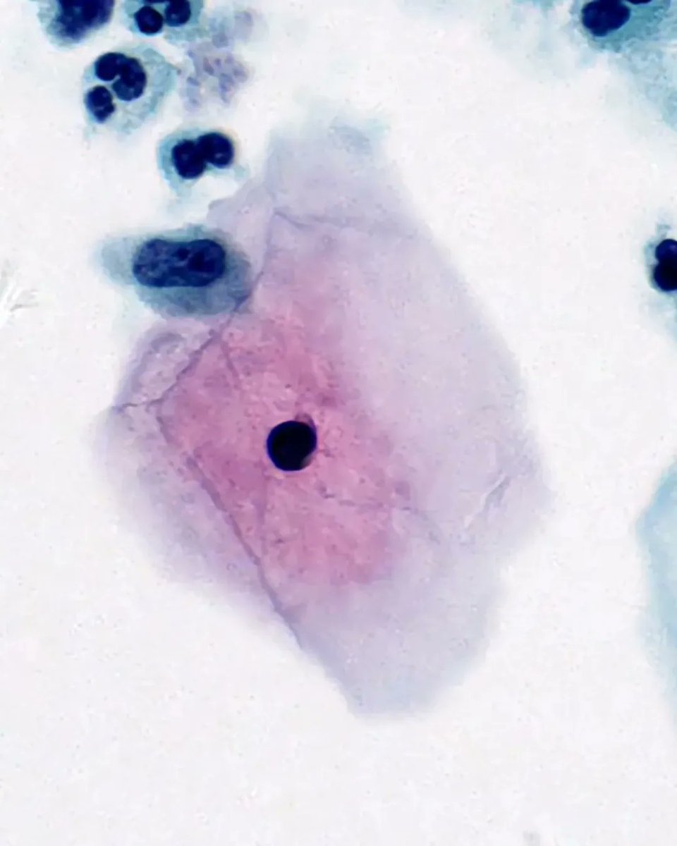 olkazuraw's tweet photo. Admiring the epithelial cell
and neutrophil morphology @100x!
This is art
Image source: Bionovation slide gallery
Stain: Papanicolaou
Sample: Cervical cast-off Cells
@clinpathkate, what do you think about the quality?
#papanicolaou
#epithelialcell
#pathart https://t.co/eZAr7vDXY9