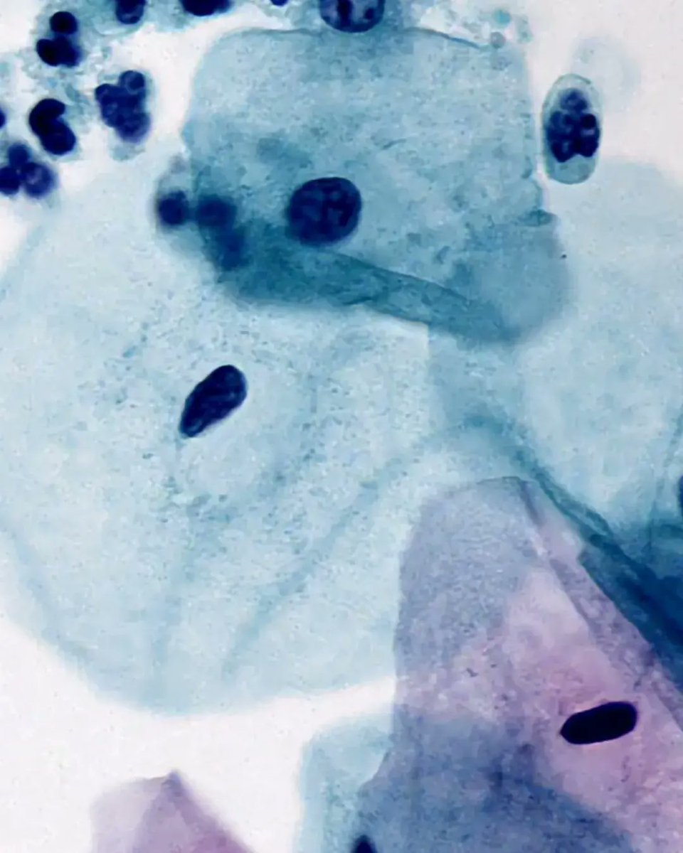 olkazuraw's tweet photo. Admiring the epithelial cell
and neutrophil morphology @100x!
This is art
Image source: Bionovation slide gallery
Stain: Papanicolaou
Sample: Cervical cast-off Cells
@clinpathkate, what do you think about the quality?
#papanicolaou
#epithelialcell
#pathart https://t.co/eZAr7vDXY9