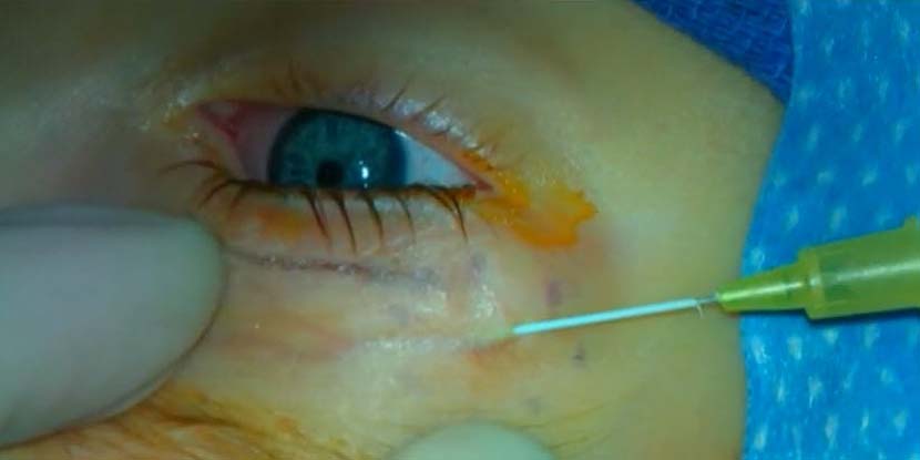 Prominent, superficial eyelid veins are unsightly and are difficult to treat. Watch how <a href="/RichardAllenMD/">Richard C. Allen MD</a> uses an angiocath with electrocautery to treat these veins. ow.ly/bot850NJlHG #oculoplastics