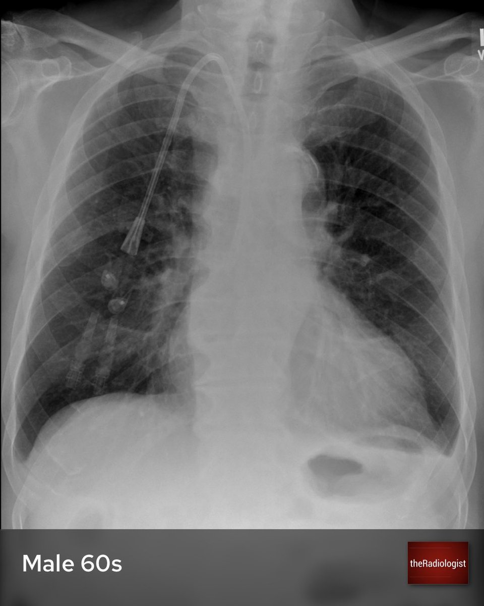 radiologistpage's tweet photo. A male in his 60s has a check X-Ray after placement of a catheter for dialysis. Any issues? https://t.co/UO6kS8tfLy