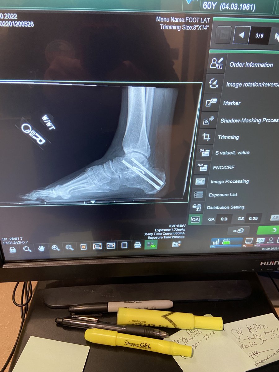 orangesmokey's tweet photo. ⁦@TigerWoods⁩ I had the same exact surgery as you. Good luck with your recovery and a little side note. I’m going golfing today for the first time in over a year. Take care https://t.co/wS6uSEl6Rt