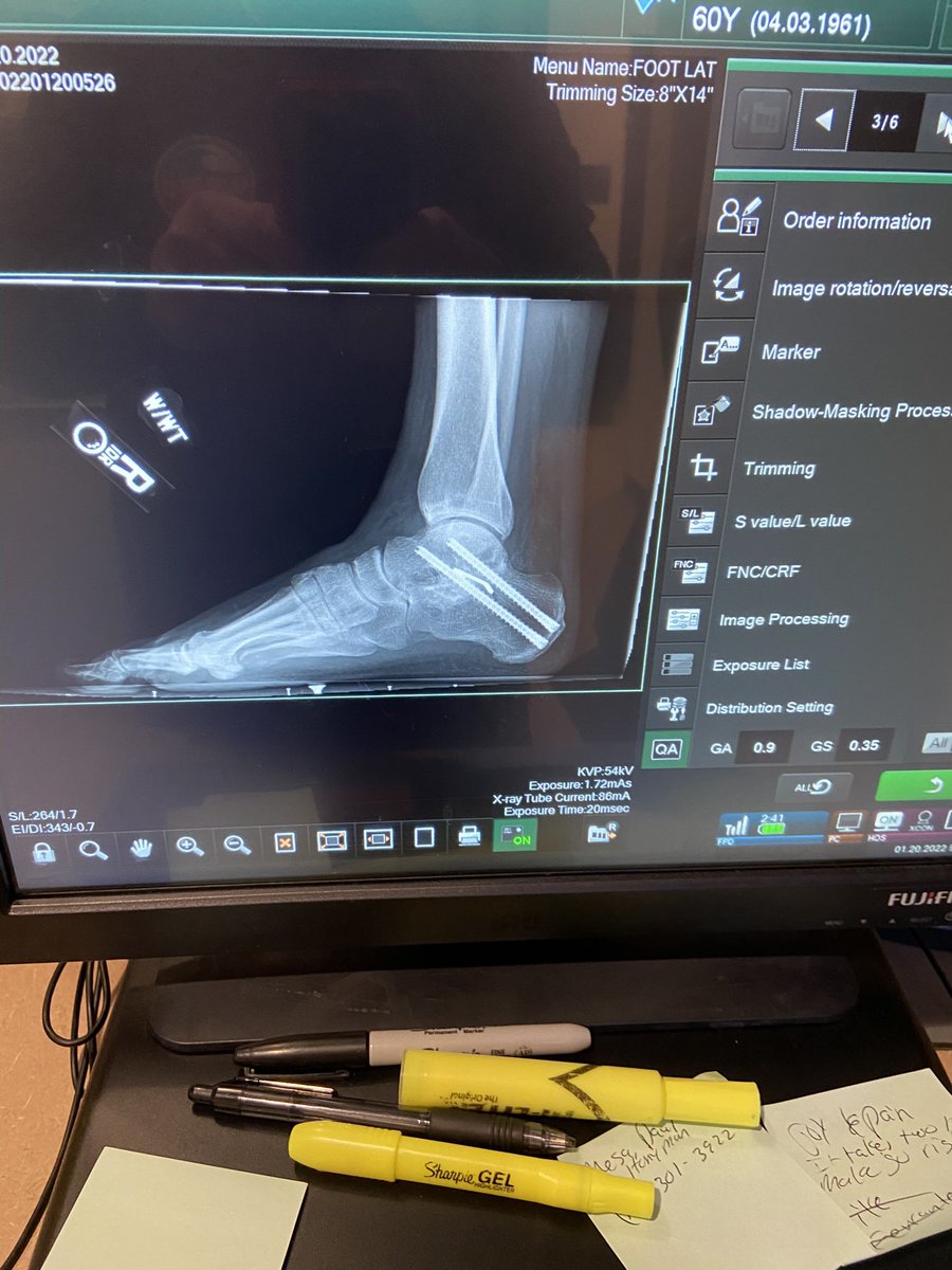orangesmokey's tweet photo. @TigerWoods I had the same surgery as you over a year ago and I know you got this. I’m going golfing today for the first time in a year. Hang in there and take your time. Best wishes https://t.co/wxbx96iDfc