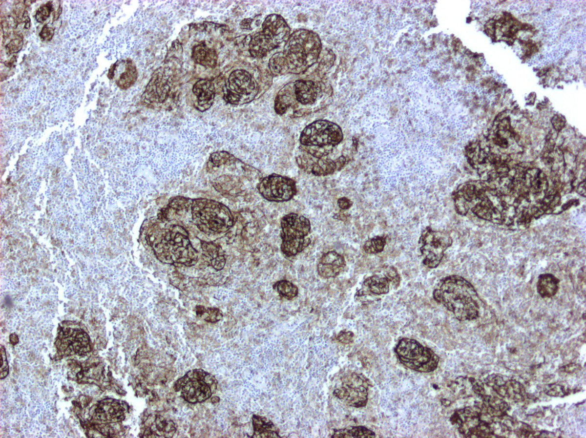 #hemepath I guess this would qualify as 'microfollicles' - CD21 stain in FL grade 2