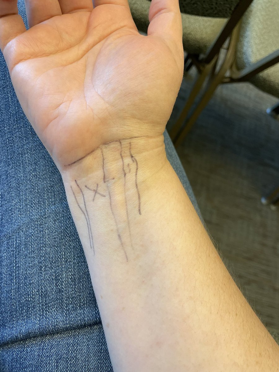 rr2mars's tweet photo. #SRPC2023 I got to be a hand model woot   X marks the spot for carpal tunnel injection https://t.co/vFn9uIHejY