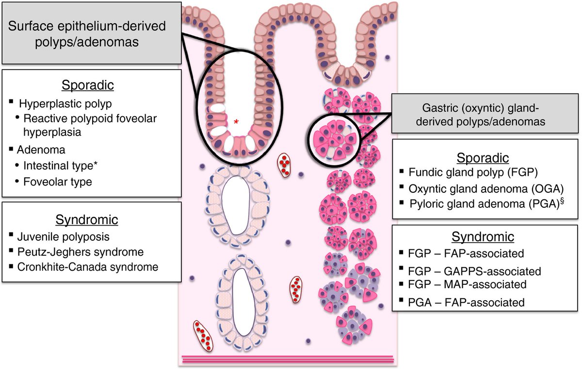MoreXGrok's tweet photo. @drkeithsiau FUNDIC GLAND POLYPOSIS ASSOCIATED WITH PROTON-PUMP INHIBITOR USE

most common type of gastric polyps found on upper endoscopy

sporadic or can be associated with an inherited polyposis syndrome

Ddx https://t.co/1w4Rm4L6gW