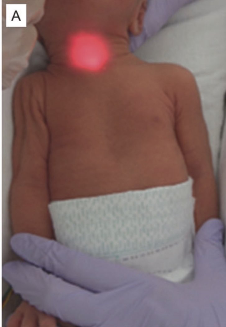 NICU_Musings's tweet photo. Light emitting diode on the end of an NG tube. 
How genius is that?
Never put food accidentally into a lung again
https://t.co/9uDzadfba0
#neoTwitter https://t.co/EyX0l7TrxK