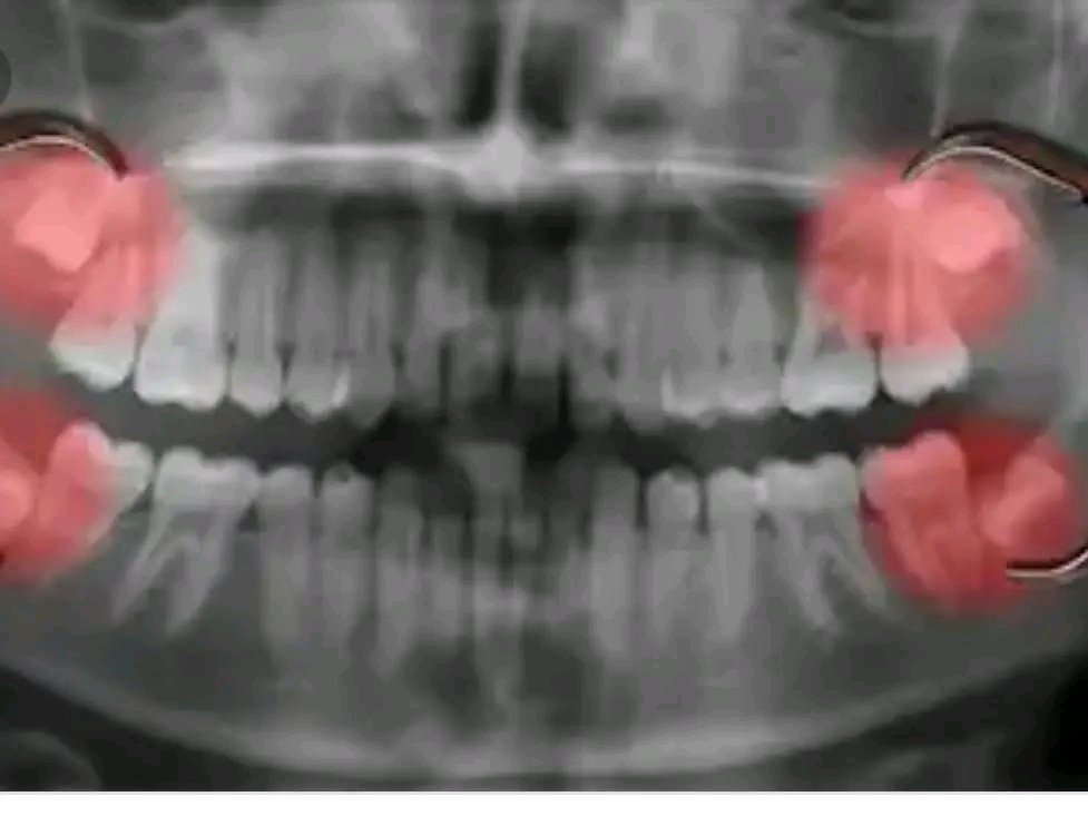jackinto433442's tweet photo. @miraboi pls Boss I need your help to sort out my dental problem, this is really giving me issue for some months now I will be greatful for any amount
and help you can render to me , I have drop account several times but nothing has drop for me.
7034881654
Okay
Jack adunye https://t.co/FsxgaFenL9