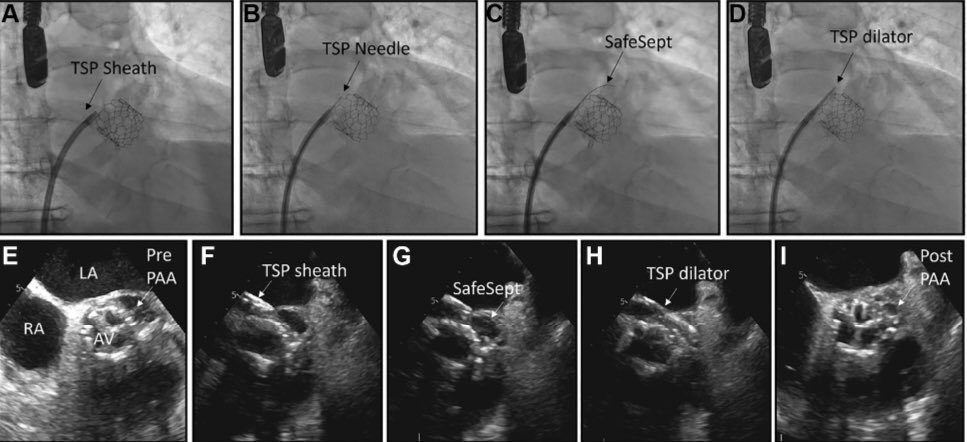 Many unmet needs in treating infective endocarditis- periaortic abscess in high surgical risk patients is one- Transseptal percutaneous drainage for periaortic abscess (n=1) - is it an option? Hot off the press in #JACCINT jacc.org/doi/10.1016/j.…