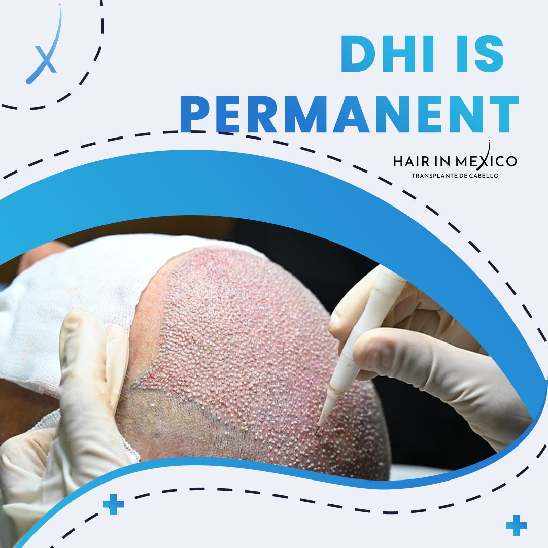 DHI is a permanent solution for hair loss. 
#hairtransplants #hairtransplantationincancun #hairinmexico #clinicinmexico #clinicincancun #beardtransplantation #dhihairtransplantation #dhihairtransplantcancun #implantecapilar
#implantecapilar #dhi #hairimplant #cabellosano