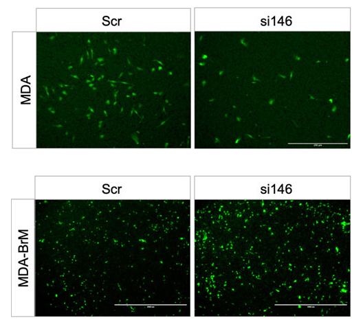 MammaryCell's tweet image. Dr. Graham Cook at @LeedsMedHealth led this research showing that high levels of #MCAM gene expression are associated with poor prognosis in #BreastCancer because they reflect tumor #vascularization and high levels of EMT.

📍 @FrontCellDevBio | 🔗 bit.ly/3GYYeul