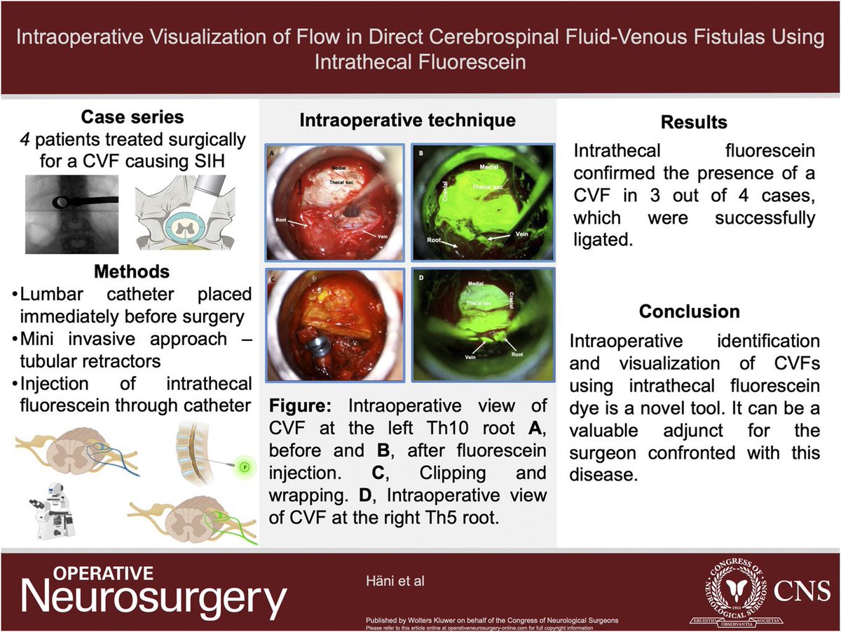 Very cool to see the use of Fluorescein to visualize CVFs intraoperatively.   Saw this at the Freiburg #SIH meeting and was impressed!

pubmed.ncbi.nlm.nih.gov/37068025/