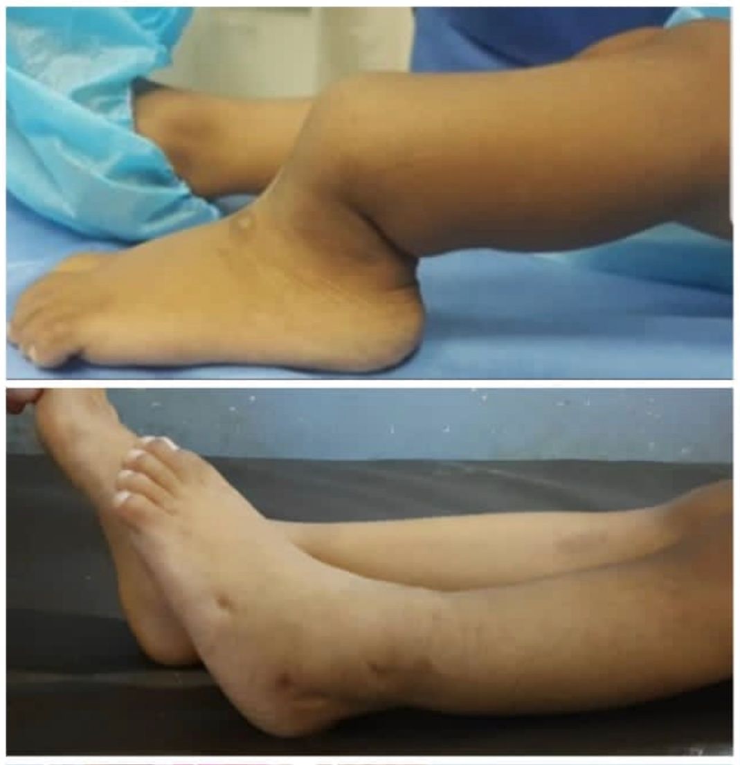 ¡Histórico! 

#Venezuela 🇻🇪  reporta la primera curación a nivel mundial de Pseudoartrósis Congénita de Tibia con aplicación de Células Madre derivadas de un donante sano.