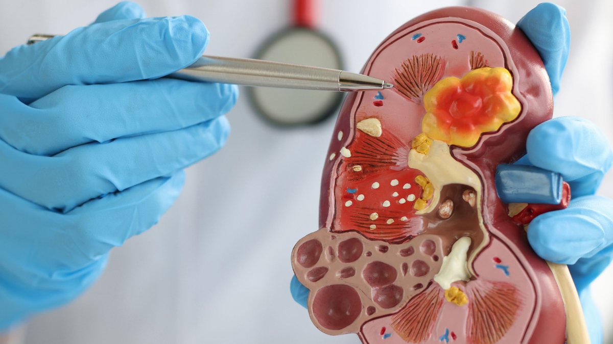 New research has found that inhibiting a specific protein, PRMT1, can inhibit the growth of kidney cancer cells by blocking the cells’ ability to repair DNA and replicate, which may lead to a novel therapeutic strategy in the treatment of kidney cancer.

bit.ly/3LhZawq