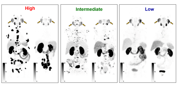 Newly developed PSG score improves patient selection for PSMA radiopharmaceutical therapy, according to a new study in <a href="/JournalofNucMed/">JNM</a> 
ow.ly/QTlK50NNRim 

#NuclearMedicine #RPTherapy #ProstateCancer #JNuclMed