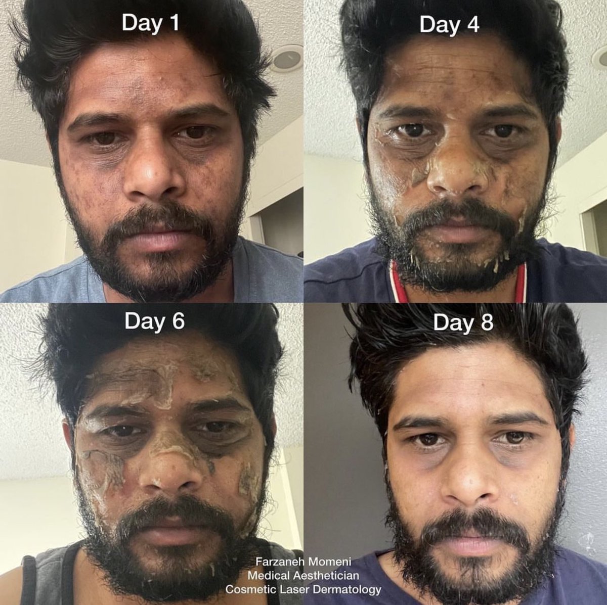 TheCosmeticLane's tweet photo. VIPeel/Chemical Peel transformation after 8 days. ✨

Would you try this treatment? https://t.co/4GzSPUokSn