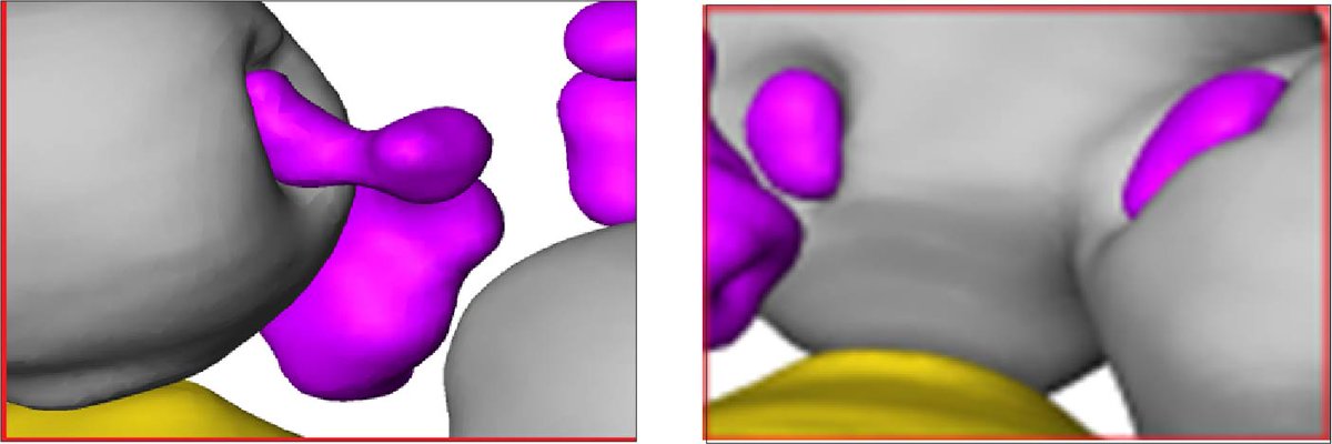 EmSontagMU's tweet photo. It could! We see cytoplasmic misfolded protein compartments interacting with vacuoles and deforming the vacuolar membrane, almost like they are being pulled in to the vacuole. #proteinclearance #autophagy #vacuole 5/12 https://t.co/dh5WuGNiNA