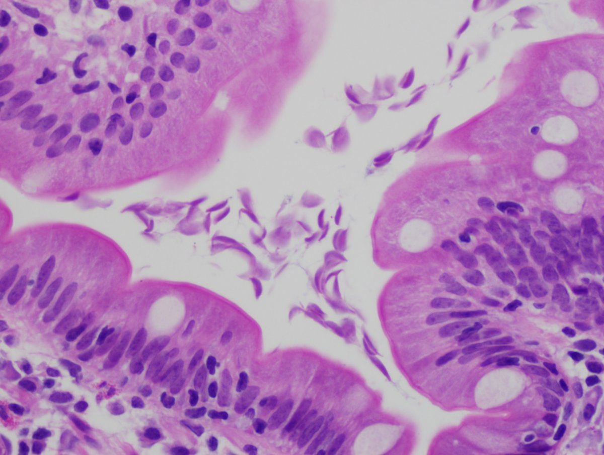 smlungpathguy's tweet photo. Giardia:  https://t.co/K4LwkIFw4h https://t.co/1U80Ies4GC
