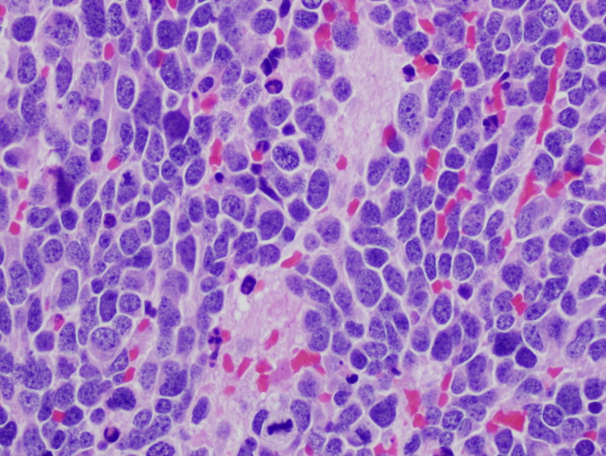 smlungpathguy's tweet image. Neuroblastoma: IHC = NB84 kikoxp.com/posts/24240