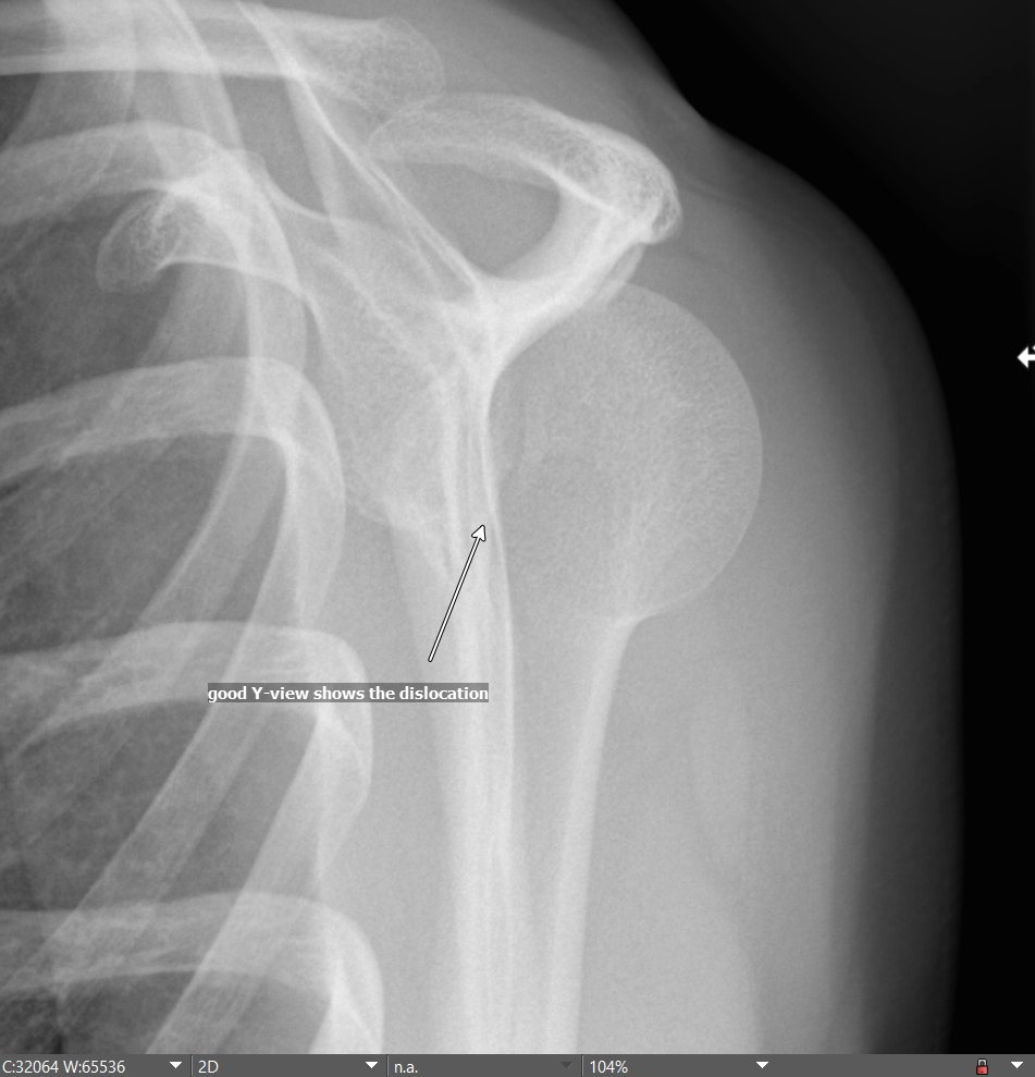 Jan Fritz (@janfritzmsk) on Twitter photo MSK RADIOGRAPHY PEARL: Posterior shoulder dislocation is difficult to diagnose on AP view. Axillary view is ideal but often not possible. Y-view needs to be near perfect (see below). Grashey and Velpeau views are very useful as well. <a href="/ssr_rwg/">SSR_RWG</a> <a href="/intskeletal/">International Skeletal Society | ISS</a> <a href="/nyu_mskrad/">NYU_MSK Radiology</a> <a href="/SSRbone/">Society of Skeletal Radiology</a> MSK RADIOGRAPHY PEARL: Posterior shoulder dislocation is difficult to diagnose on AP view. Axillary view is ideal but often not possible. Y-view needs to be near perfect (see below). Grashey and Velpeau views are very useful as well. <a href="/ssr_rwg/">SSR_RWG</a> <a href="/intskeletal/">International Skeletal Society | ISS</a> <a href="/nyu_mskrad/">NYU_MSK Radiology</a> <a href="/SSRbone/">Society of Skeletal Radiology</a>