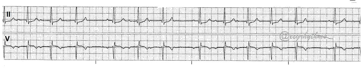 ecgrhythms's tweet photo. 042023
From the📦/📧 by a 🫂
#BasicECG
Difficulty level (out of 5⭐️): ⭐️⭐️
What is your ECG dx? Poll next
#FOAMed
#MedEd
#MedTwitter
#CardioTwitter
#EPeeps https://t.co/7QR7k9vD03