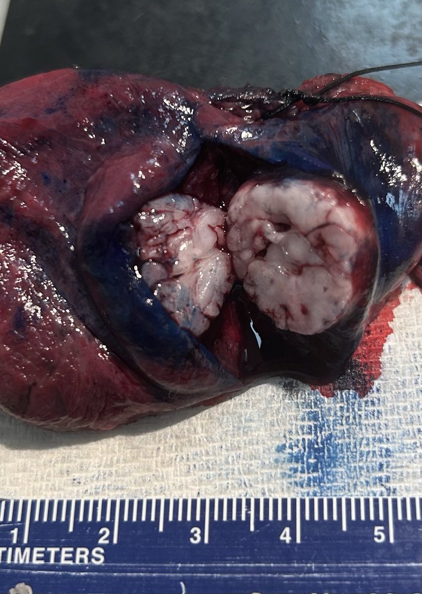 #Pulmpath #Pathresidents #Surgpath
#Grosspath 

60 year old smoker with a 2cm lung mass of indeterminate nature - wedged out & sent for frozen.

#Pathresidents: Diagnosis?