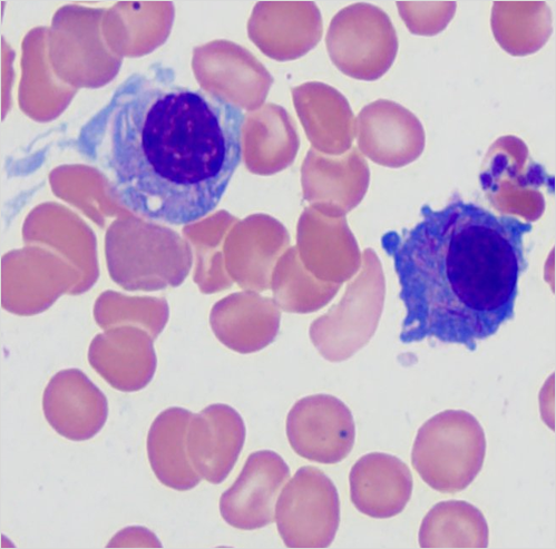 SibaElHussein's tweet photo. Plasma cell neoplasm, crystal-storing variant➡️
🩸Eosinophilic crystal deposition in plasma cells, mimicking crystal-storing histiocytosis
#hemepath #lymsm #mmsm #MedTwitter #pathtwitter #surgpath https://t.co/O3MQJxkeoj