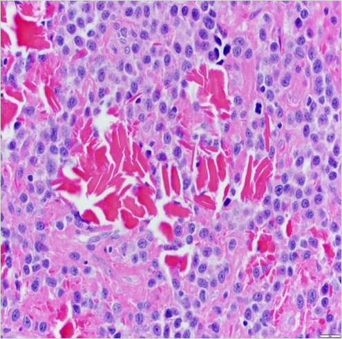SibaElHussein's tweet photo. Plasma cell neoplasm, crystal-storing variant➡️
🩸Eosinophilic crystal deposition in plasma cells, mimicking crystal-storing histiocytosis
#hemepath #lymsm #mmsm #MedTwitter #pathtwitter #surgpath https://t.co/O3MQJxkeoj