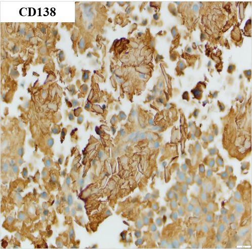 SibaElHussein's tweet photo. Plasma cell neoplasm, crystal-storing variant➡️
🩸Eosinophilic crystal deposition in plasma cells, mimicking crystal-storing histiocytosis
#hemepath #lymsm #mmsm #MedTwitter #pathtwitter #surgpath https://t.co/O3MQJxkeoj