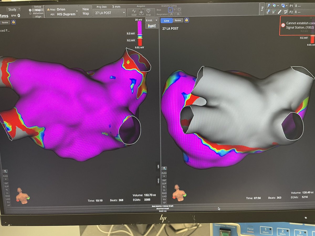 Very excited to enroll and treat our first Farapulse PFA patients this week with @BSCCardiology and PI @VivekReddyMD as part of the Advantage AF study. And right on the heels of fresh MANIFEST-PF data. The future is bright for PFA and our patients!